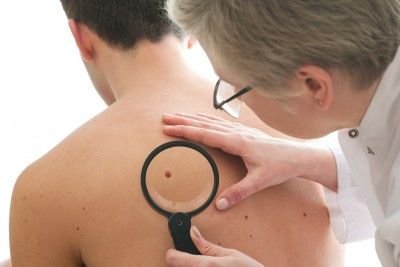 When Should You Worry About Your Moles?
